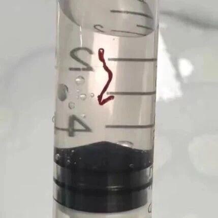 输液时抽出“虾线”状血条！？我还有救吗……