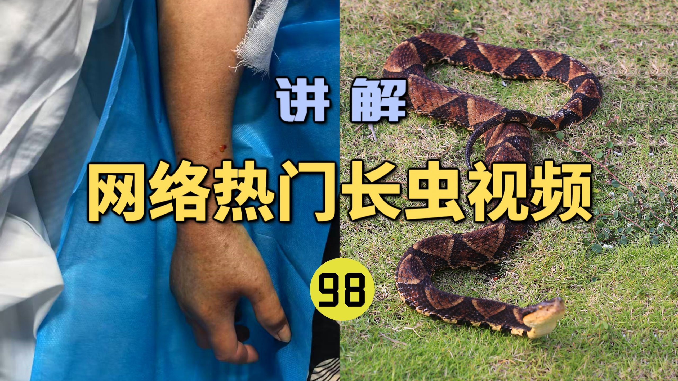 网络热门长虫视频(98)老人在山上被五步蛇咬伤！打了16支血清才脱离生命危险？